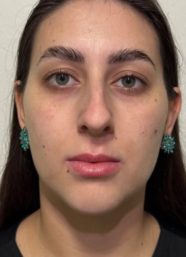 Antes: Harmonização facial