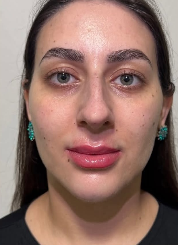 Depois: Harmonização facial